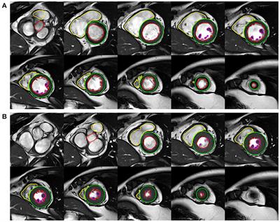 Biventricular Morphology and Function Reference Values Derived From a Large Sample of Healthy Chinese Adults by Magnetic Resonance Imaging